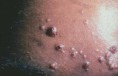 /album/fotogaleria/cripto-disemin-lesiones-molusco-contagioso-like-jpg/